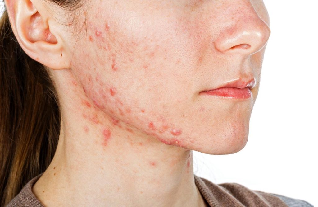 Acne na gravidez: por que sair e como tratá -lo