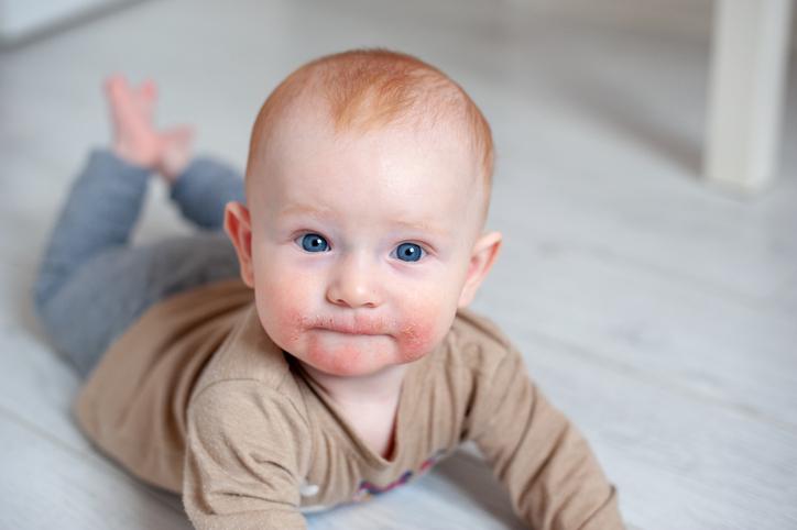 Alergia alimentar em bebês: sintomas