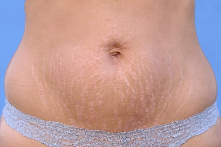 Como diminuir a barriga flácida após a gravidez