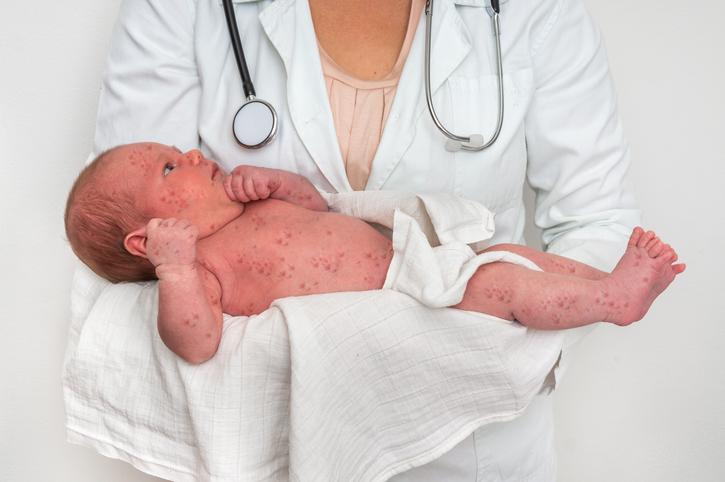 Herpes neonatais: o que são