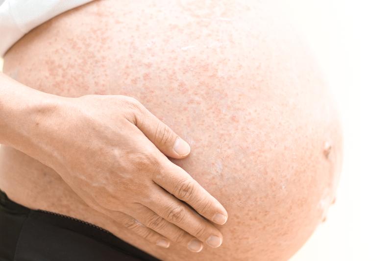 Coceira na barriga na gravidez: por que isso acontece e como aliviá -lo