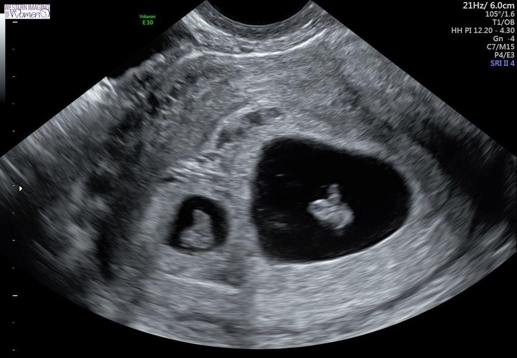 O que acontece se houver dois sacos gestacionais de tamanho diferente na gravidez